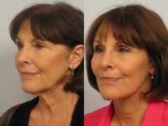 Dr. Michael A. Persky - Case Study – Lower Facelift and Necklift Los Angeles, CA