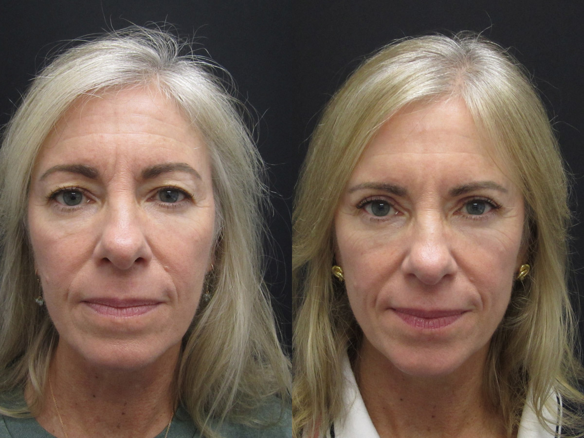 blepharoplasty 03