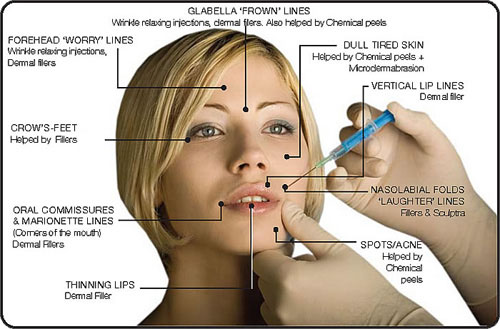 Dr. Michael A. Persky - Newest Indication for Number-One Prescribed Facial Aesthetic Treatment in U.S.  Can Help Improve Appearance of Lines Around the Eyes