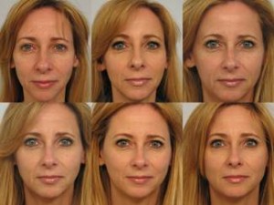Dr. Michael A. Persky - There’s Something About Sculptra…What’s New With Sculptra 2015 @ Persky Sunder Facial Plastic Surgery Los Angeles?